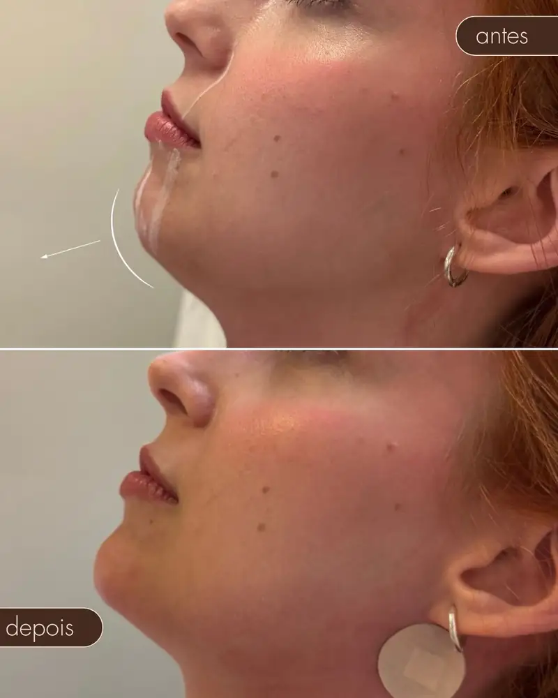 Antes e depois — Preenchimento de mandíbula